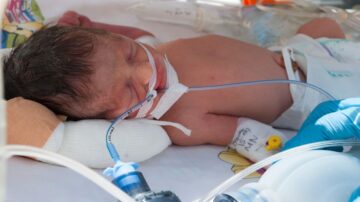 رضيع نائم على سرير مستشفى، متصل بأنابيب طبية. يظهر على وجهه علامات التعب، ويتم دعم تنفسه بواسطة جهاز. ملابس الطفل بسيطة، ويظهر في الخلفية بعض المعدات الطبية.